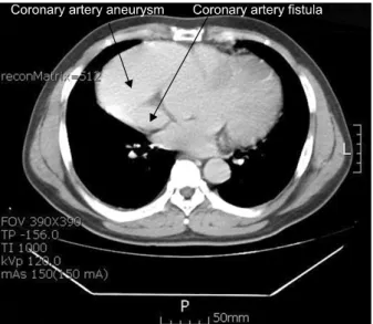 Fig. 2. Preoperative coronary angiography showing the fusiform  aneurysm involving right coronary artery.