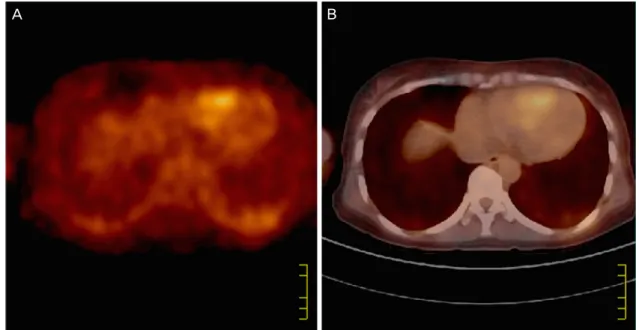 Fig. 1. Positron-emitting computed tomography of heart taken on August 11, 2008. (A) It shows higher fluorodeoxyglucose uptake of right  ventricle comparing the left
