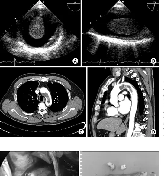 Fig. 1. Transesophageal echocardio- echocardio-graphic cross-sectional (A) and  lon-gitudinal images (B) show a long,  floating thrombus in the aortic arch