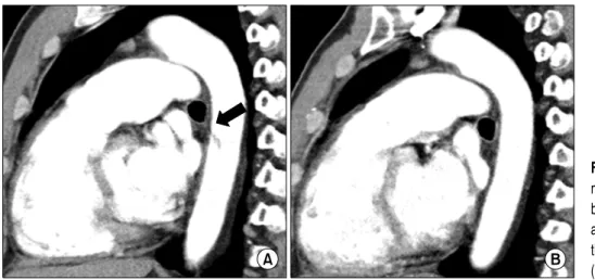 Fig. 3. Changes in Computed to- to-mographic images. A small  throm-bus originates in the descending  aorta (A)