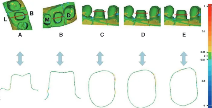 Fig. 5. 2-dimensional cross-sectional analysis of abutment tooth. (A) Buccal-Lingual section, (B) Mesial-Distal section,  (C) Transverse High section, (D) Transverse Middle section, (E) Transverse Low section