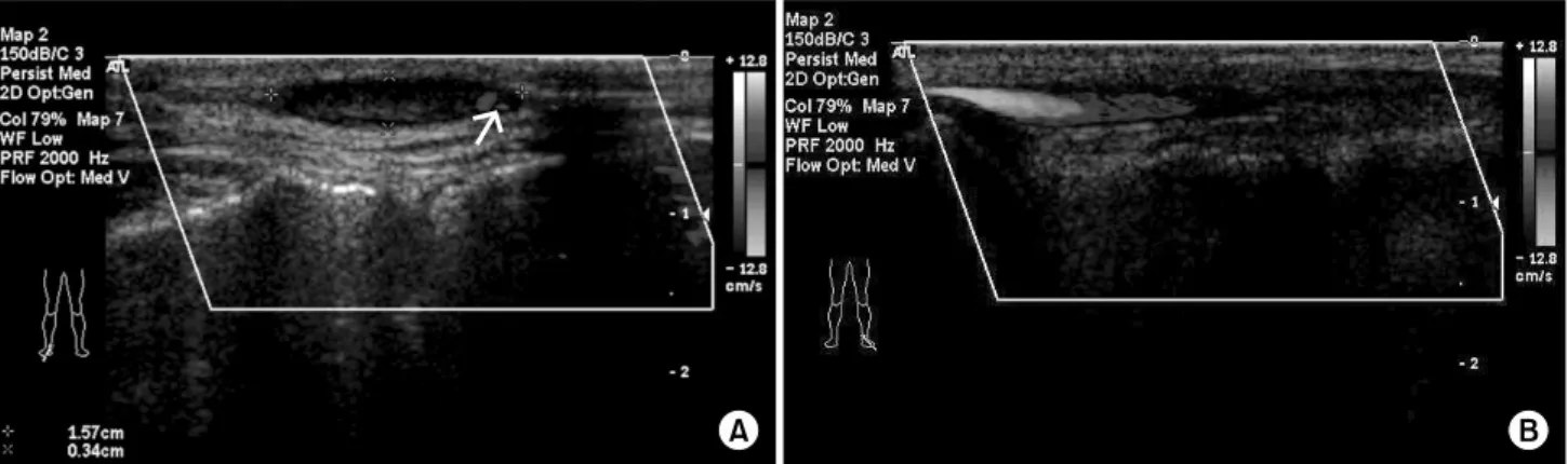 Fig. 2. (A) Preoperative Doppler sonography view in supine position. Note well-defined anechogenic cystic lesion showing 1.57×0.34 cm  sized aneurysmal dilatation in vein of dorsum of foot