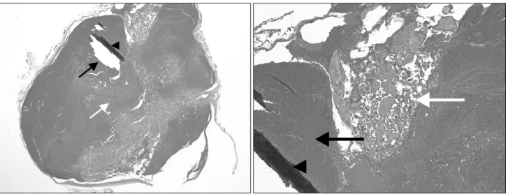 Fig. 3. Histologic finding of resected aneurysm. Microscopic examination showing aneurismal dorslis pedis vein with whole venous vessel  component