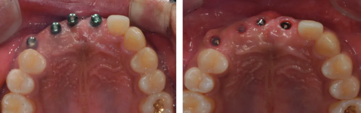 Fig. 3. Healing abutment for 2nd surgery.