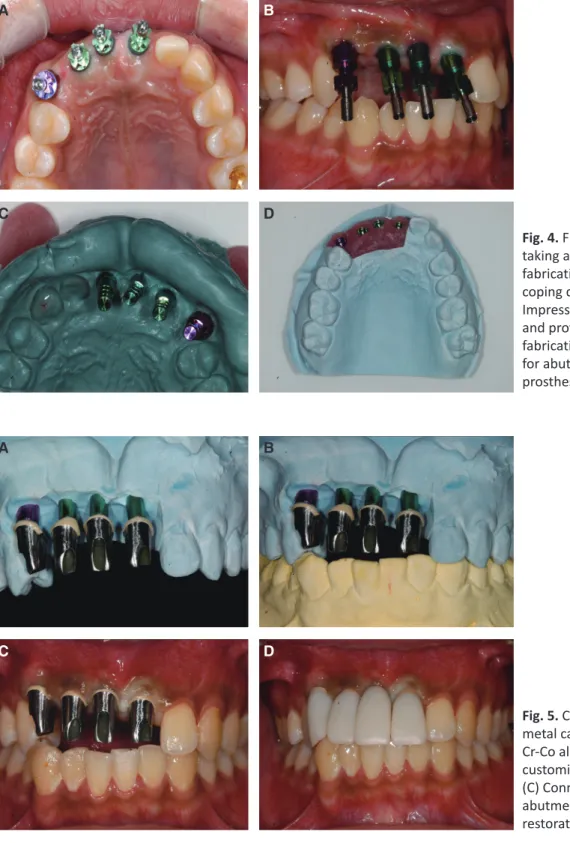 Fig. 4. Fixture level impression  taking and master cast  fabrication. (A, B) Impression  coping connection, (C)  Impression for abutment  and provisional prosthesis  fabrication, (D) Master cast  for abutment and provisional  prosthesis fabrication.