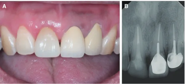 Fig. 4. (A) Intraoral photo and (B) Periapical radiograph after final cementation.