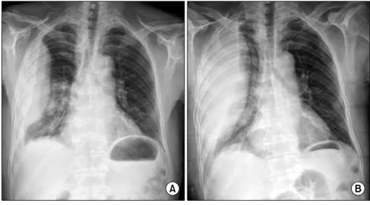 Fig. 1. (A) Preoperative chest PA  showed D-shaped outline with its  base located against the  corre-sponding part of the chest wall (B)  second chest x-ray three hours  later.