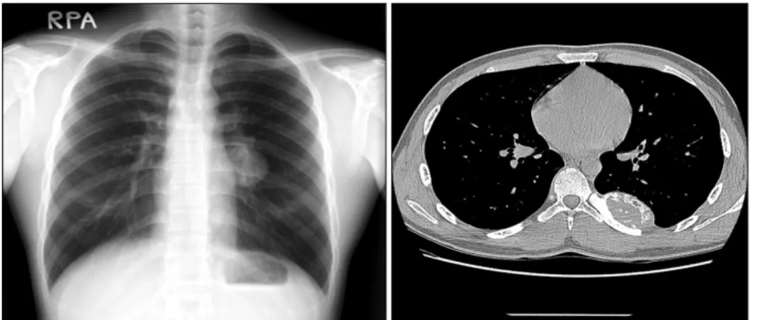 Fig. 1. Pre-op CXR &amp; CT.