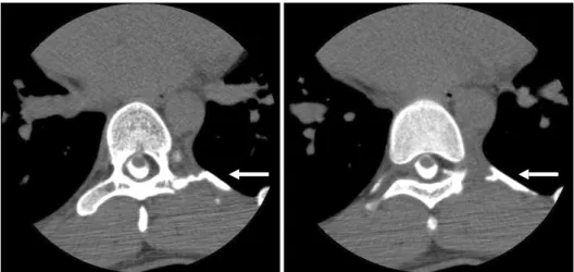 Fig. 4. CSF leakage to pleural cav- cav-ity thorugh fistula (white arrow).