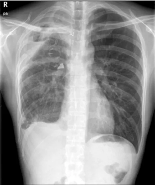 Fig. 2. Postoperative chest x-ray showing roll-gauzes packed in  the thoracic cavity for bleeding control.