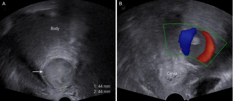 Fig. 2. Computed tomography revealed (A) leakage of contrast media (arrow) from the left uterine artery (before embolization), (B) no evi- evi-dence of contrast media leakage (after embolization).