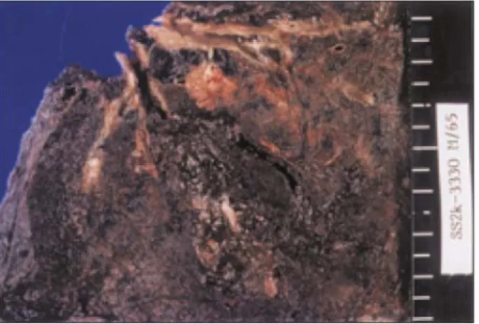 Fig. 2. Pathohistologically, there are sheets of tumor cells  that have nuclear atypia and melanin pigment  (×400, HE).