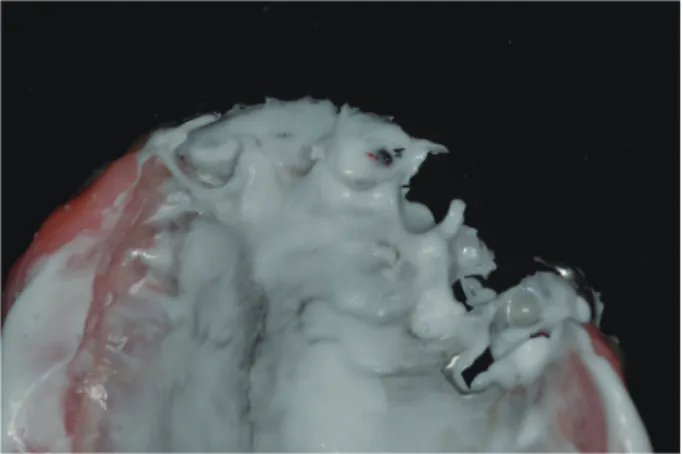 Fig. 5. Verification of the fit of definitive complete  contour zirconia surveyed crown to the existing PRDP.