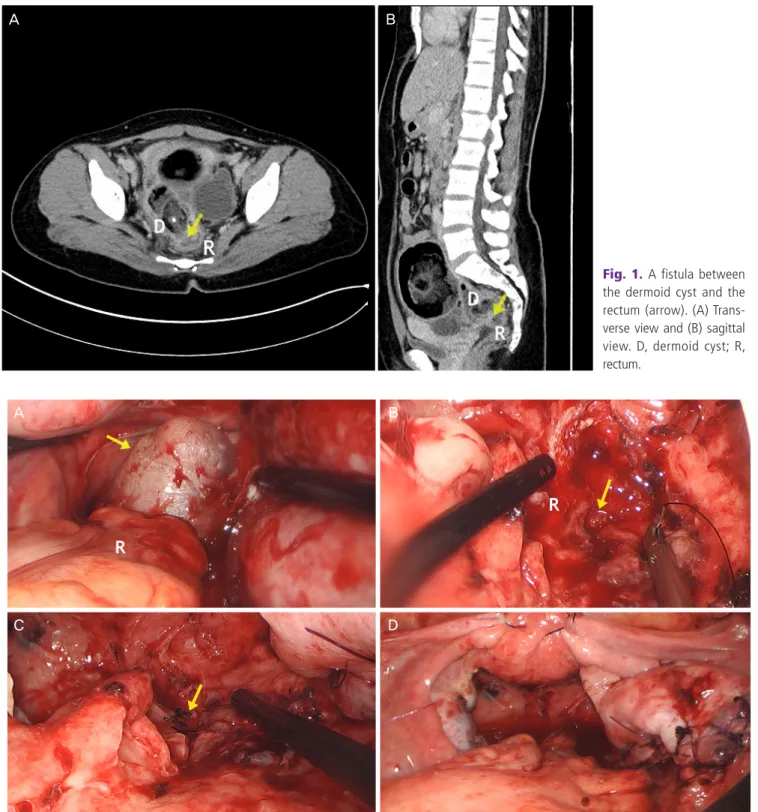 Fig. 2. Laparoscopic view. (A) Previously ruptured contents of the right ovarian dermoid cyst (arrow)