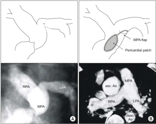 Fig. 3. (A) Preoperative angio- gram and postoperative CT  angio-gram in an 8-month-old boy with  TOF