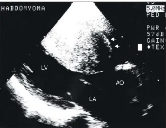 Fig. 3. Postoperative echocardiogram 5 year after the oper- oper-ation: There were no signs of remnant tumor growth or left  ventricular outflow tract stenosis.