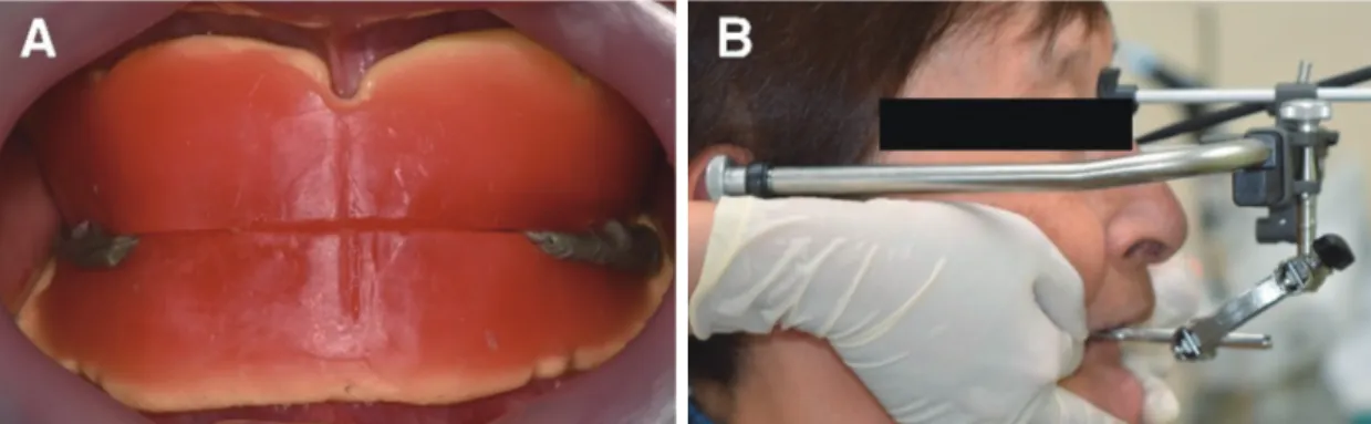 Fig. 4. (A) Vertical &amp; horizontal jaw relation record, (B) Facebow transfer.