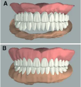 Fig. 9. (A), (B) Occlusal adjustments and border modifications on try- try-in dentures, (C), (D) Closed-mouth, functional impression and bite  registration using try-in dentures.