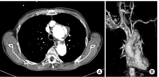 Fig. 3. (A) Postoperative CT an- an-giography shows the type II  endo-leak at the left side of aortic arch