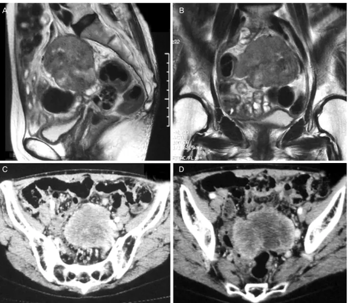 Fig. 1. Magnetic resonance (A-C) and contrast-enhanced computed tomography (D) images revealed a solid tumor of the left ovary,  70×50 mm in diameter