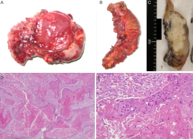 Fig. 2. Macroscopic findings of the left ovary (A) and sigmoid colon (B). Squamous cell carcinoma (SCC) directly invaded the submucosal  layer of the sigmoid colon (C)