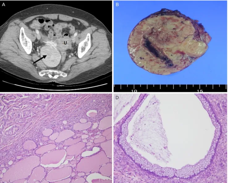 Fig. 1. (A) Contrast-enhanced computed tomography shows a well-defined hypervascular solid mass (arrow) in the right adnexa (uterus [U])