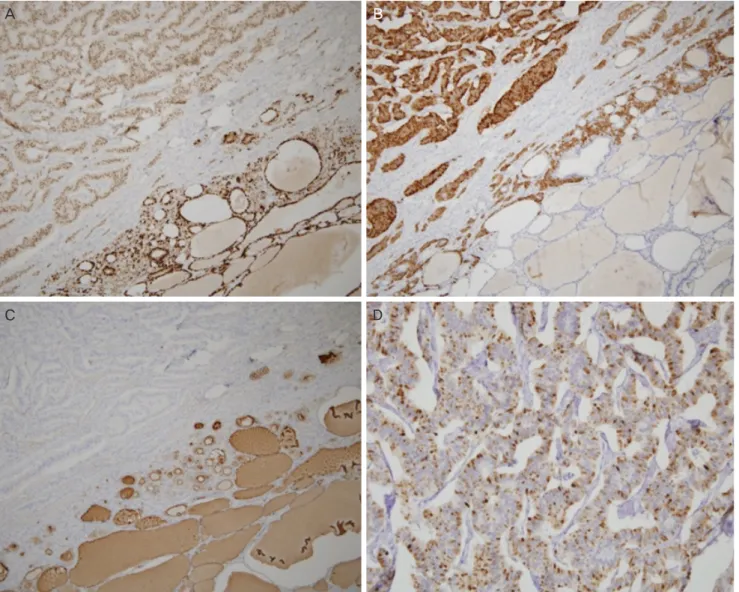 Fig. 2. Immunohistochemical staining. (A) The tumor cells are diffusely positive for PAX8