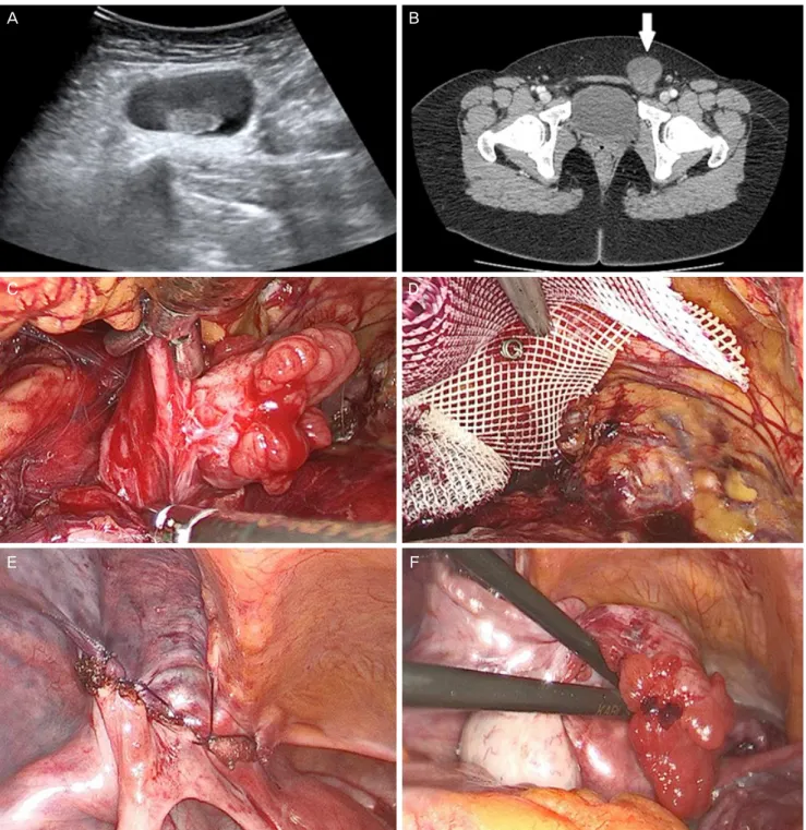 Fig. 1. (A) Ultrasonographic image showing the left hydrosalpinx in the hernia sac. (B) Computed tomography image of the pelvis show- show-ing a 6×4 cm cystic structure in the show-inguinal area (white arrow)