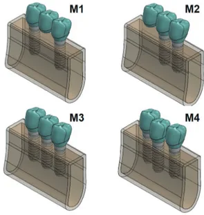 Fig. 2. M1, M2, M3, and M4 models of implant-supported  FDPs with various alignments and configurations.