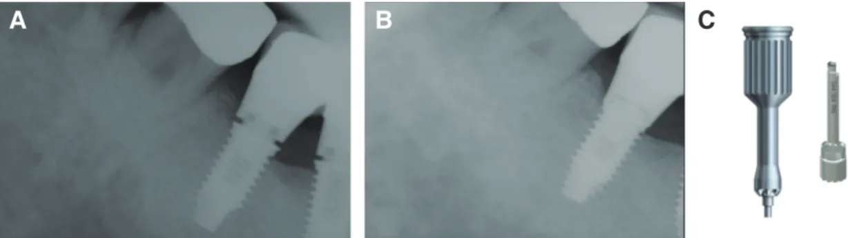 Fig. 3. (A) Prosthesis cannot be placed due to overgrowing distal bone. (B) After bone profiling with instruments, the  prosthesis can be placed completely