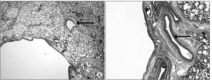 Fig. 3. Histology finding shows an irregular dilated bronchiol like a cyst (arrow; H&amp;E stain, ×40) and a feeding artery (arrow; H&amp;E stain, 