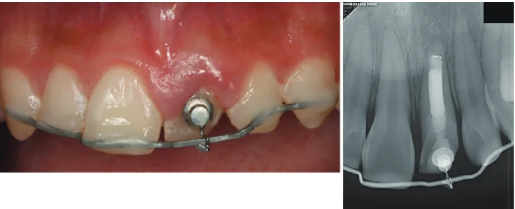 Fig. 2. After a 10-week orthodontic extrusion and followed by a 6-week retention phase