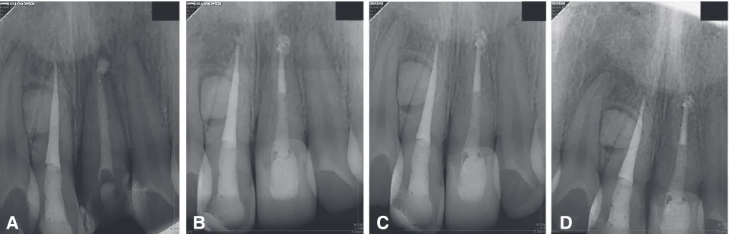 Fig. 5. Buccal view of coronally positioned root splinted with composite resin to maintain tooth stability and sutured (A)