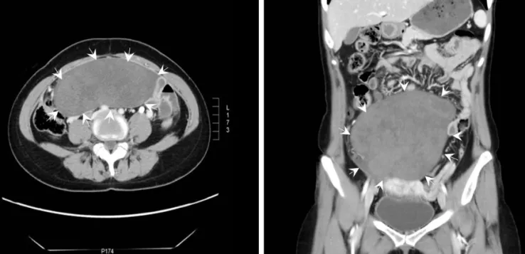 Fig. 1. Preoperative computed tomography imaging of the mass. (A) Axial and (B) coronal computed tomography reveal a well-defined,  lobulated heterogeneous mass in the lower abdomen.