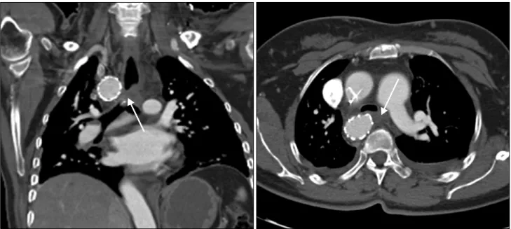 Fig. 4. Postoperative computed tomogaraphy after hybrid operation. The arrows show the sites of previous Kommerell’s diverticulum, which  became roomy after stent graft insertion.