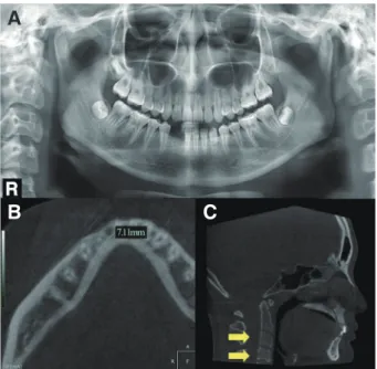 Fig. 4. Temporary anchorage devices (TADs) were placed at 2 - 3 mm under the alveolar crest and temporary artificial  teeth with loop were placed