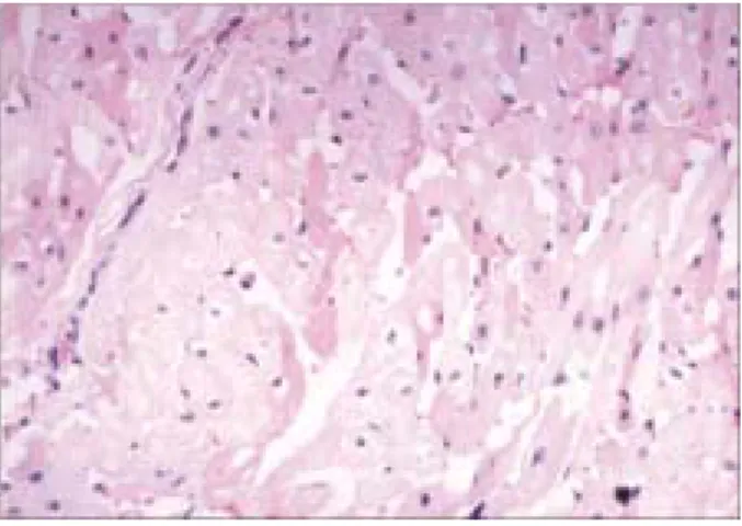 Fig. 3. Scattered ischemic myocardium showing eosinophilic  cytoplasmic condensation and loss of nuclei (H&amp;E stain,×200).