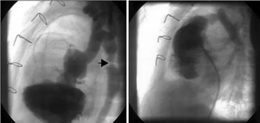 Fig. 5. Postoperative cardiac doppler shows minimal TR. 