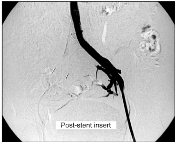 Fig. 2. Phlebography shows left common iliac vein with 12 mm  wall stent. Venous flow is good and stenotic lesion of left  com-mon iliac vein is disappeared.
