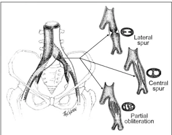 Fig. 3. Schematic diagram shows the relationship of the left  common iliac vein and right common iliac artery