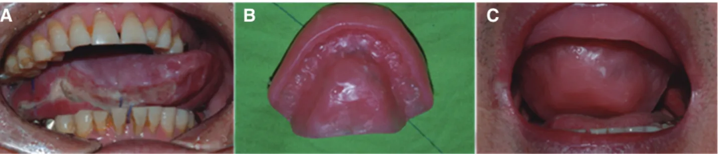 Fig. 5. Ventilation holes for airway patency in patient 6. 