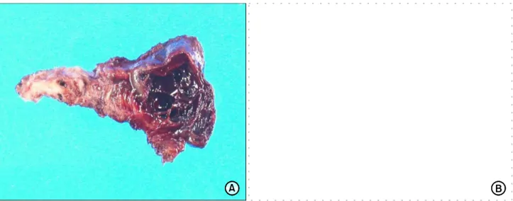 Fig. 1. Preoperative endoscopic  finding  (A) and EUS (B).