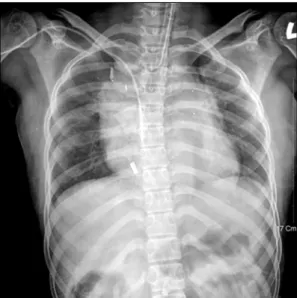 Fig. 4. CT scan in case 2 shows huge hematoma compressing  over right atrium and ventricle.