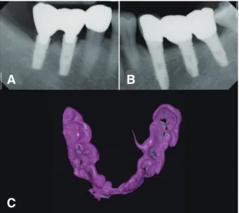Fig. 2. Lowered occlusion induced by axial displacement. 
