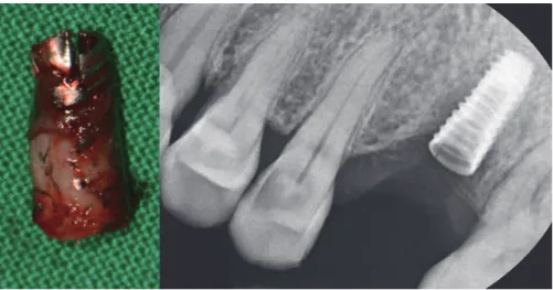 Fig. 6. Distribution of coronal wall thickness of commercially available ICC regular platform implant systems
