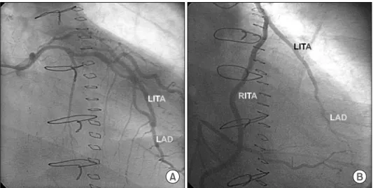 Fig. 1.  (A) Competitive flow is shown in the early postoperative left coronary artery angiography
