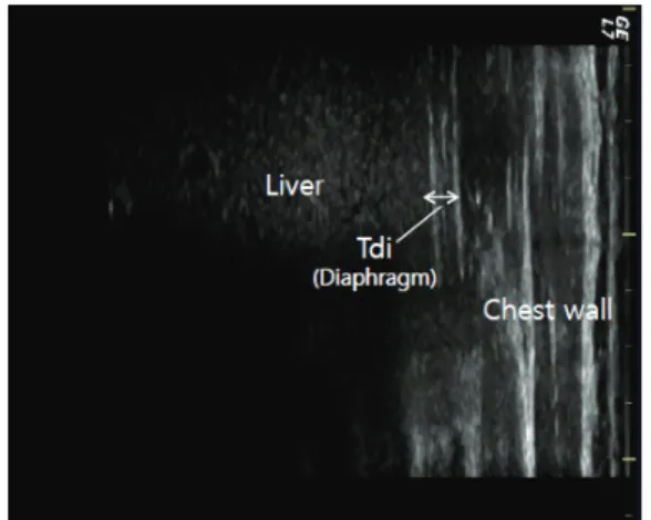 Fig. 1. Ultrasound image of the diaphragm in the zone of apposition. Tdi: diaphragm thickness