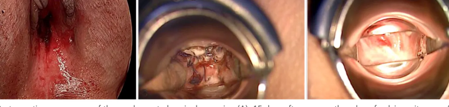 Fig. 2. Postoperative appearance of the newly created vaginal openning (A), 15 days after surgery, the edge of pelvic peritoneum (B), and  vaginal vault after surgery at 12 months (C).