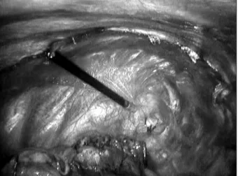 Fig. 1. Spaghetti method, apical pleurectomy by endo-peanut.