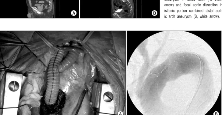 Fig. 1. Preoperative 3D thoracic  aorta CT shows thrombosed aortic  aneurysm in aortic arch (A, black  arrow) and focal aortic dissection in  isthmic portion combined distal  aort-ic arch aneurysm (B, white arrow).